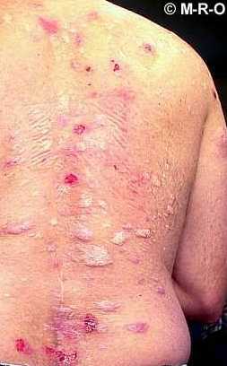 Morgellonswunden und Hautver�nderungen am R�cken, Bildquelle: http://www.morgellons-research.org/morgellons2/